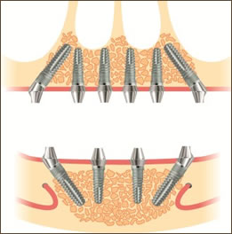 Bone Loss And Dental Implants