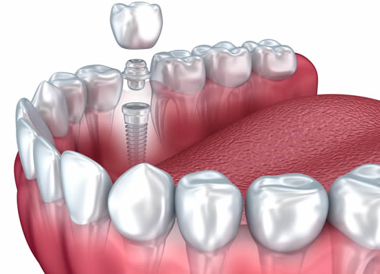 Four Reasons For Dental Implant Failure