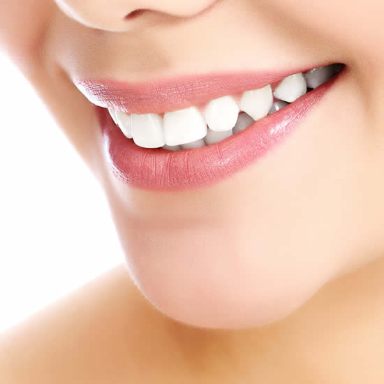 Common Misconceptions About Dental Veneers