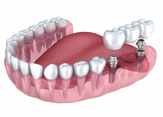 Prosthodontics – Replacing Missing Teeth At Your Local Epsom Dentist