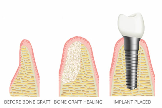 Faster Healing After Dental Implant Placement